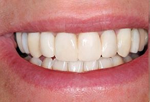 First Family Dental | Veneers, Dental Bridges and Teeth Whitening